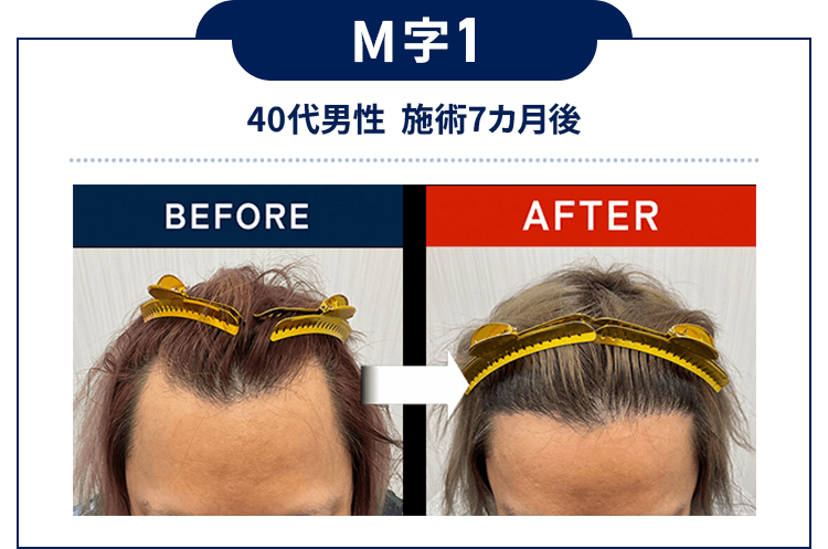 M字1：40代男性  施術7カ月後