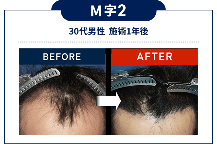 M字2：30代男性 施術1年後
