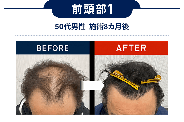 前頭部1：50代男性  施術8カ月後