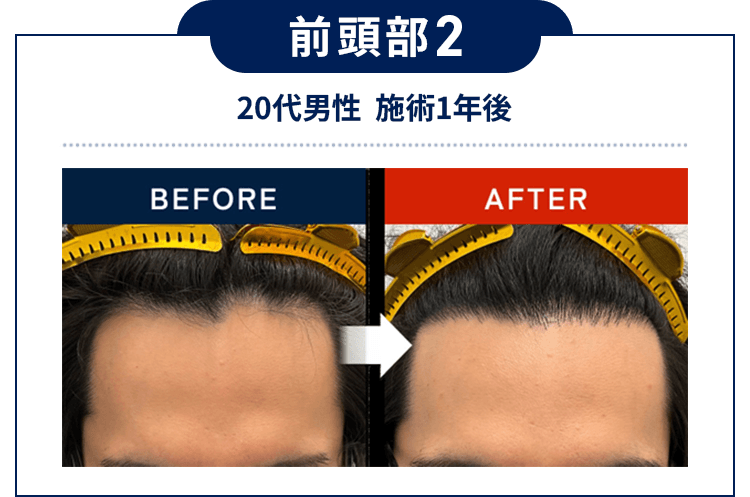 前頭部2：20代男性  施術1年後