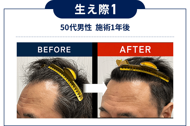 生え際1：50代男性  施術1年後